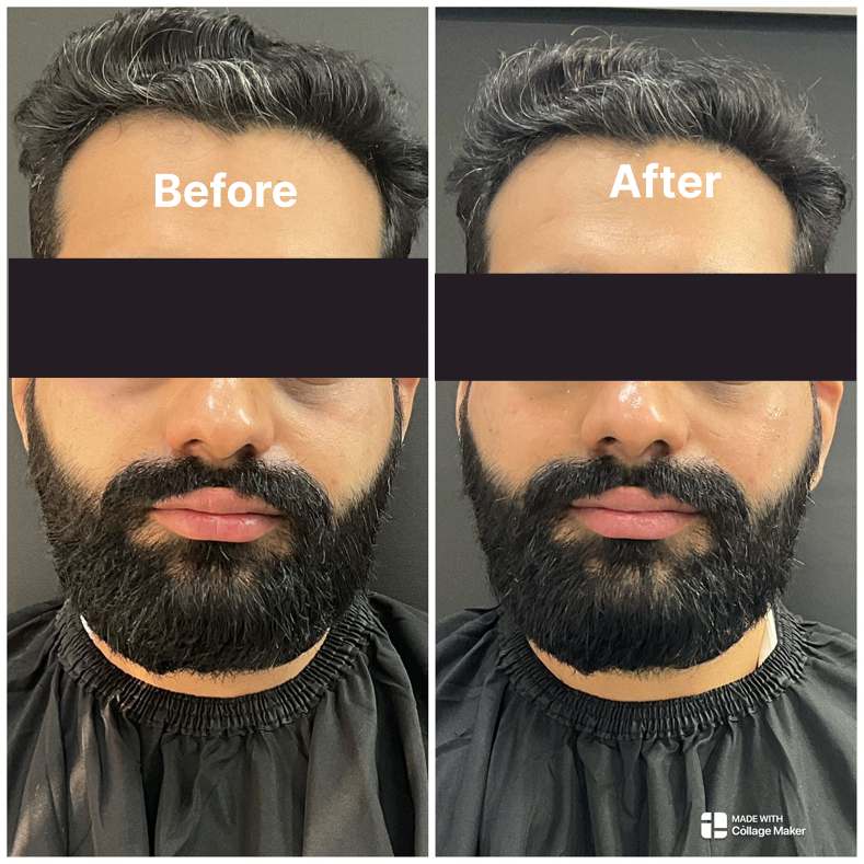 Fillers result KOQ10